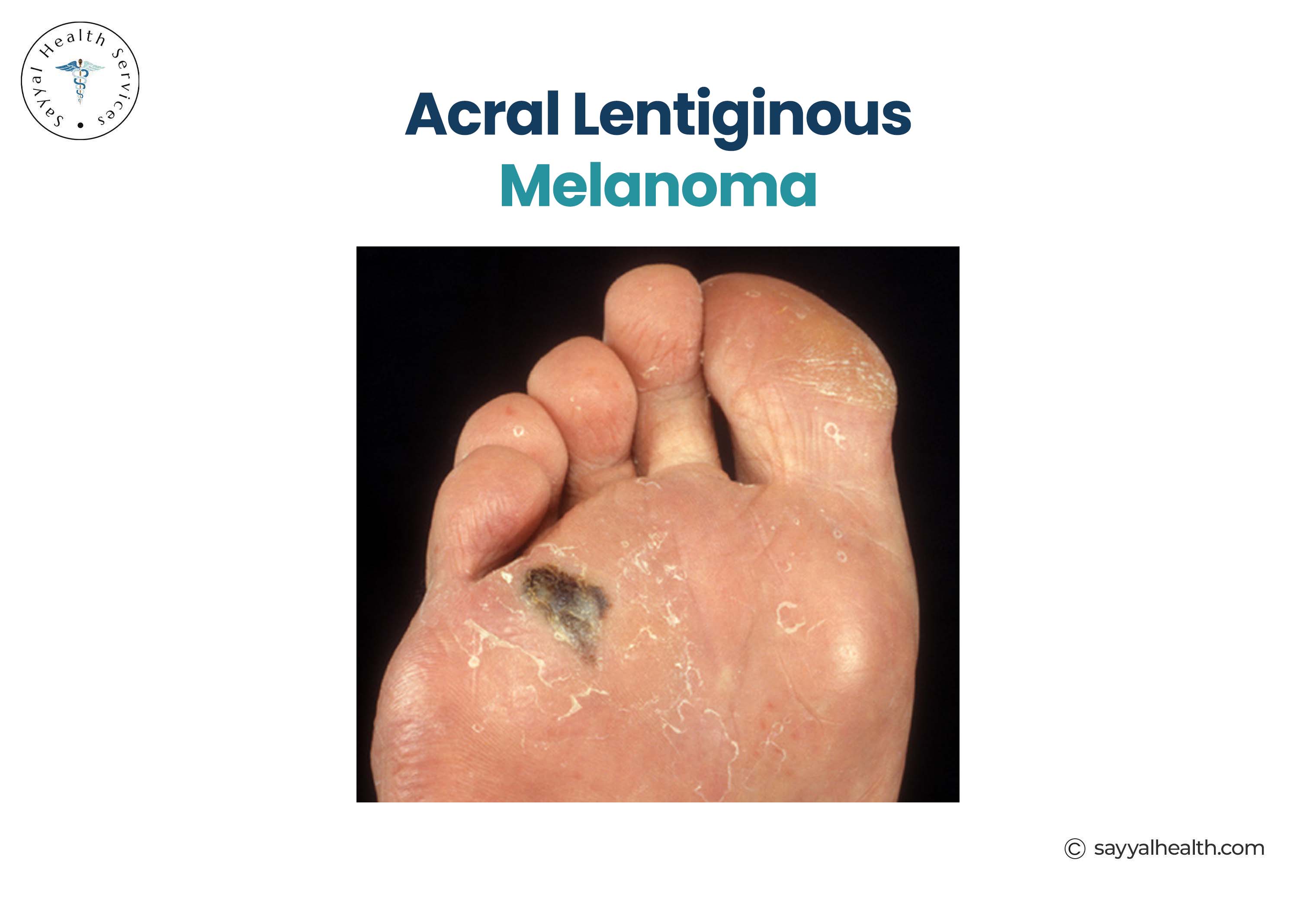 picture of acral lentiginous melanoma on the sole of foot